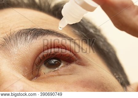 Hand Placing Drops Of Eye Drops In Inflamed Eye With Infected Stye, Upper Eyelid, Ophthalmic Medicin