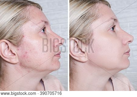 Young Woman Before And After Anti Acne Treatment, Skincare And Dermatology Concept