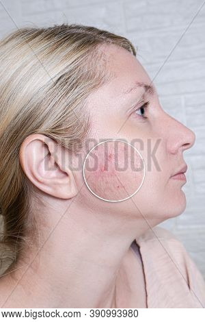 Young Woman Before And After Anti Acne Treatment, Skincare And Dermatology Concept, Skin Imperfectio