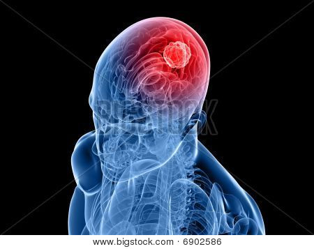 tumore cerebrale