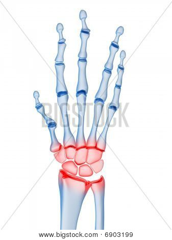 skeletal hand - arthritis