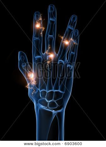 skeletal hand - arthritis