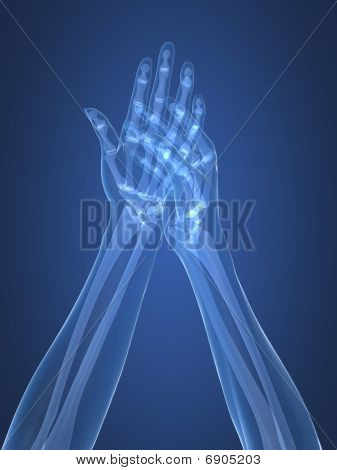 x-ray hands - arthritis