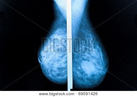 Mammography