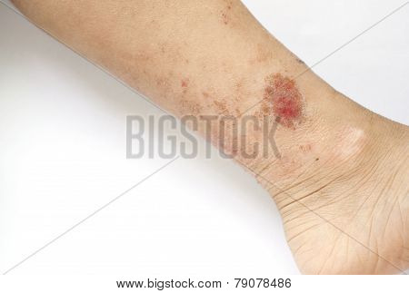 Eczema