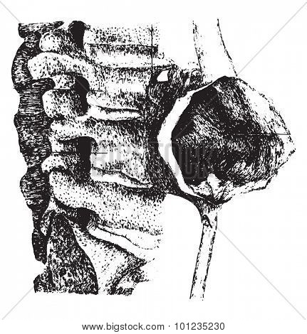 Symmetric aneurysm of the abdominal aorta, vintage engraved illustration.