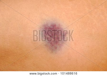 Close up of bruise on wounded woman leg skin. Gender violence concept.