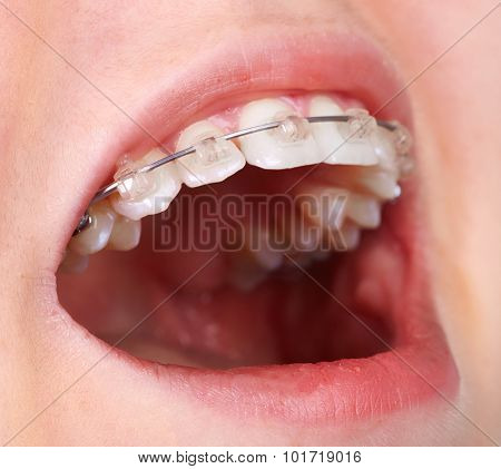 Teeth with orthodontic brackets. Dental health care.