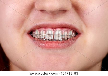 Teeth with orthodontic brackets. Dental health care.