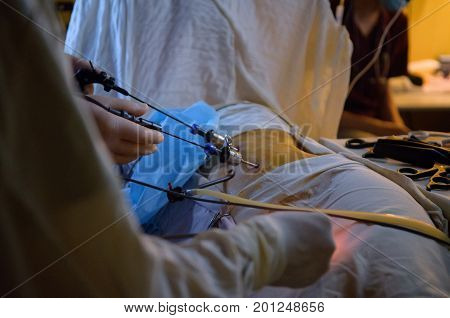 Laparoscopic Surgery Operation