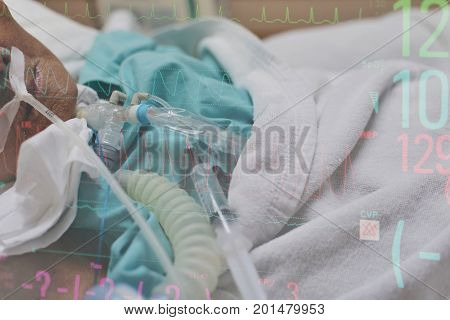 Patient Do Tracheostomy And Ventilator In Hospital