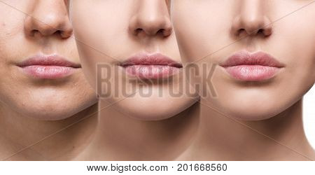 Beautiful lips of young woman. Before and after lips filler injections. Fillers concept.