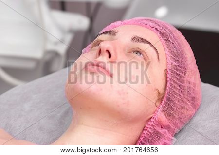Beauty clinic customer, problematic skin. Face of young woman, cosmetology. Hormones and skin health.