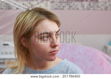 Caucasian girl with acne. Problematic face skin. Symptoms of allergic reaction.
