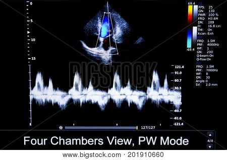 Colourful Image Of Homan Heart Ultrasound Monitor