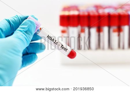 Blood sample for HbA1c test, diabetes diagnosis