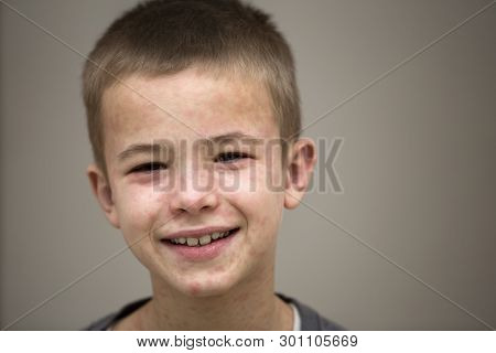 Portrait Of Sick Smiling Boy Child Suffering From Measles Or Chicken Pox With Bumps All Over Face. C