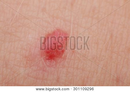 Cherry Angiomas On Male Skin - Super Macro Close Up