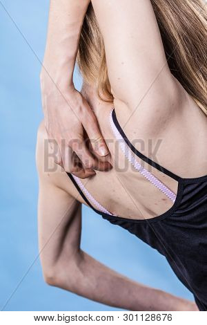 Health Problem, Skin Diseases. Young Woman Showing Her Back With Acne, Red Spots. Teen Girl Scratchi