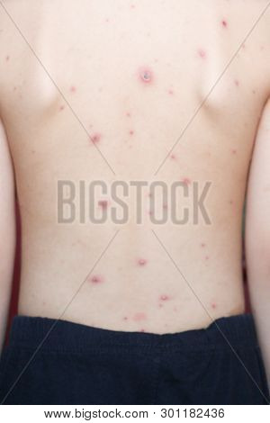 Chicken Pox Rash On Young Boy Body.chickenpox Is An Infection Caused By The Varicella Zoster Virus. 