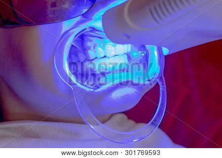 Teeth Whitening Procedure Ultraviolet Lamp Whiten Teeth Girl Mouth Extender