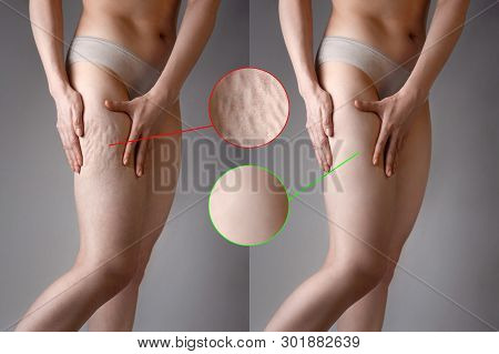 The Woman Shows Cellulite And Smooth And Delicate Skin On Her Legs. The Concept Of Aesthetic Medicin