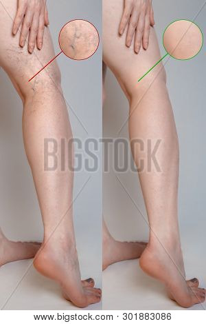 Varicose Veins Concept. Female Legs With Varicose Veins And Vasodilatation. Before And After. Magnif