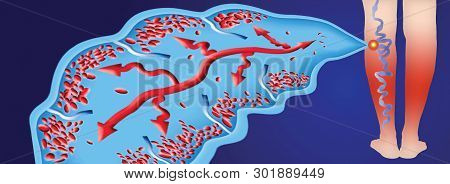 Varicose Veins On A Female Senior Legs. The Structure Of Vein. Dvt