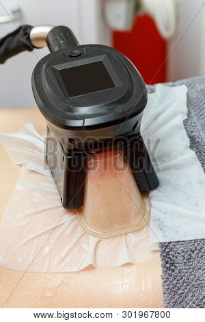 Cryolipolysis Freeze Fat Procedure In Cosmetic Cabinet Or Spa Salon, Belly Close-up