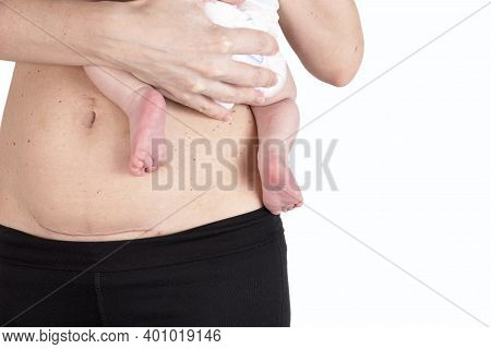 Closeup Of Woman Belly With A Scar From A Cesarean Section. Woman With Baby On Her Hand