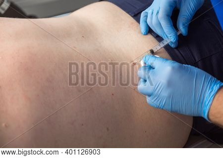 Surgeon In Gloves Gives Injection Of Local Anesthesia To Patient Before Laser Removing Of Moles Or P