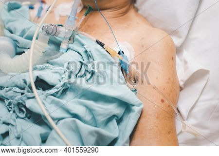 Patient Do Tracheostomy And Ventilator In Hospital