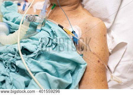 Patient Do Tracheostomy And Ventilator In Hospital