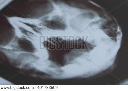 X-ray Of The Sinuses. Close-up. Checking For Chronic Purulent Diseases.
