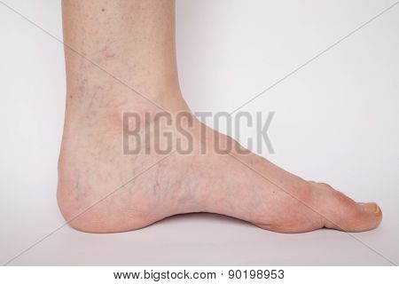 Varicose Veins Closeup