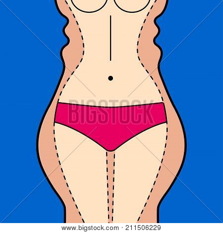 Liposuction. Liposuction hips, thighs, stomach. Removal of fat. Plastic surgery. Stock vector