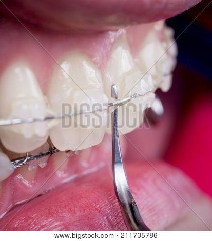 Dentist Cleaning Teeth With Ceramic Brackets Using Dental Tool At The Dental Office. Macro Shot Of T