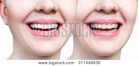 Teeth Of Young Woman Before And After Whitening And Buildup. Isolated On White.