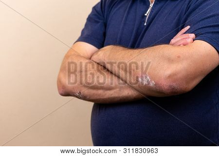 Close Up Dermatitis On Skin, Ill Allergic Rash Dermatitis Eczema Of Patient , Atopic Dermatitis Symp