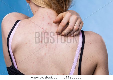 Health Problem, Skin Diseases. Young Woman Showing Her Back With Acne, Red Spots. Teen Girl Scratchi