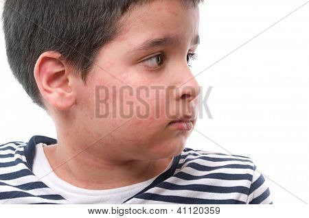 Lille barn lider urticaria