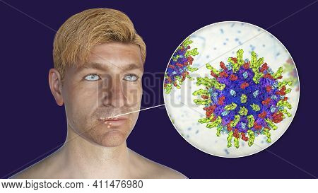 Herpes Labialis, Also Known As Cold Sores, 3d Illustration Showing Lesions On The Man's Lips Caused 