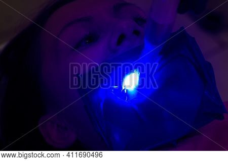 Ultraviolet Light In Dentistry, Treatment Of Upper Masticatory Teeth.