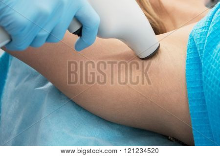 Procedure against hyperhidrosis