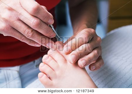 여자의 발에 발병 치료를 수행 하는 여자 (가까이)