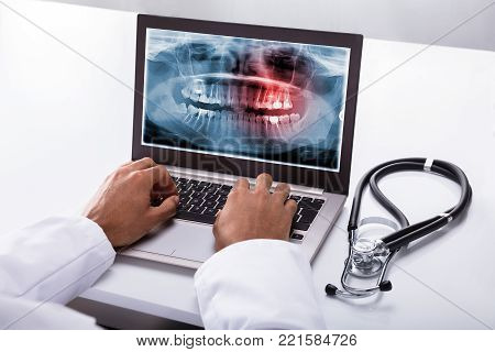Close-up Of A Dentist's Hand Typing On Laptop With Dental X-ray On Screen