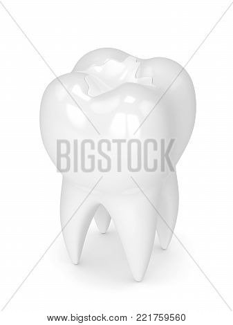 3D Render Of Tooth With Dental Composite Filling