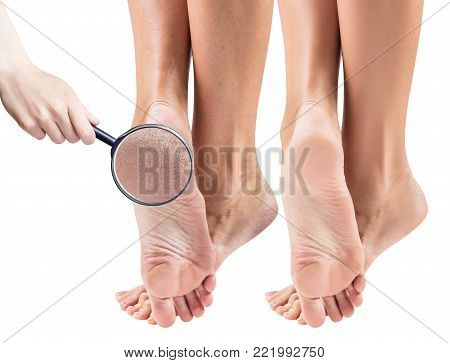 Female feet with dry skin and cracks before and after treatment. Zoom by magnifying glass. Isolated on white background.