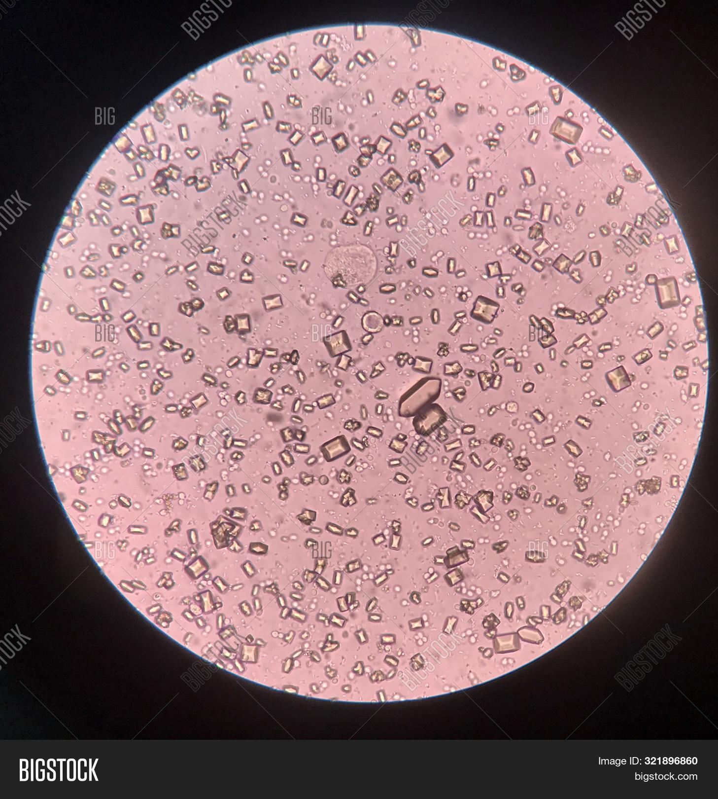 Sel Ragi Urin Yeast Cells In Urine Test