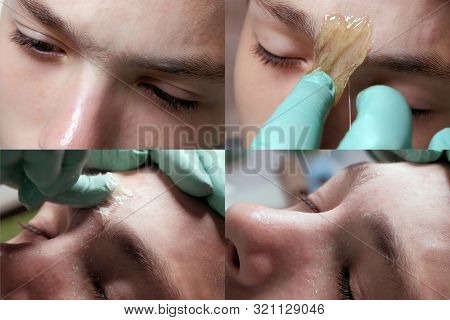 The Process Of Removing Hair Between The Eyebrows. Teen Guy On A Cosmetic Procedure. Close-up Of A T